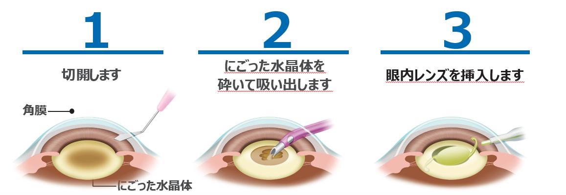 白内障手術の方法