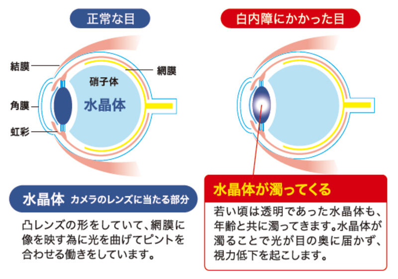 正常な目と白内障の比較