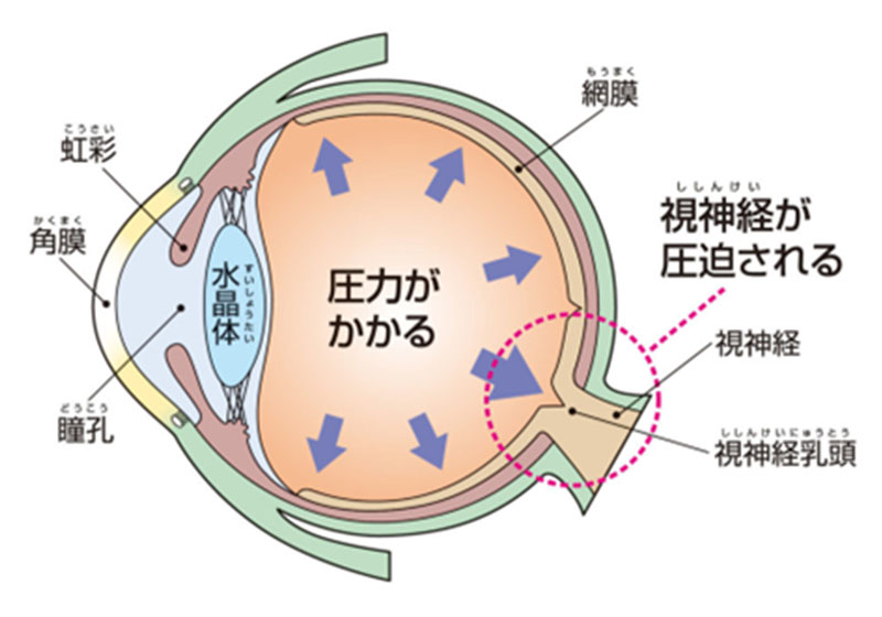 緑内障とは