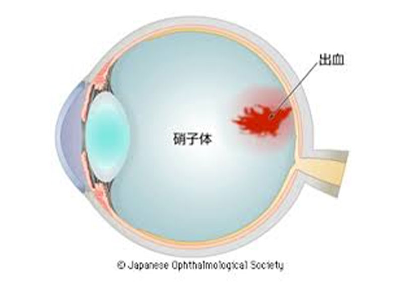 硝子体出血･混濁