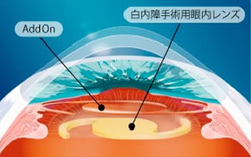 アドオン眼内レンズ