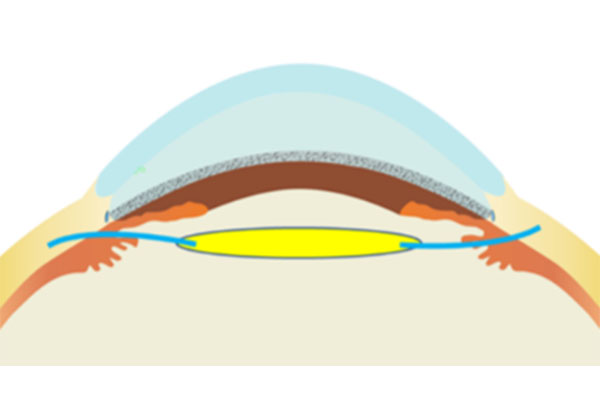 レンズを直接強膜に固定