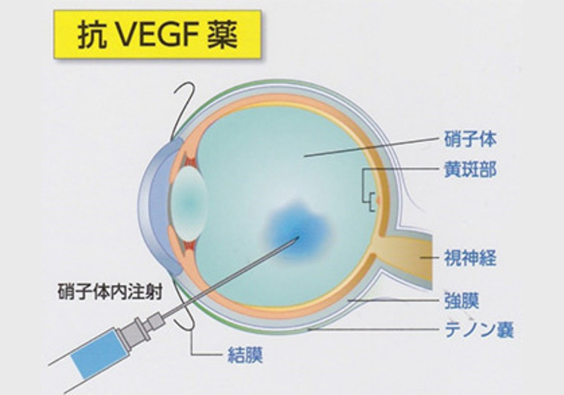 硝子体注射