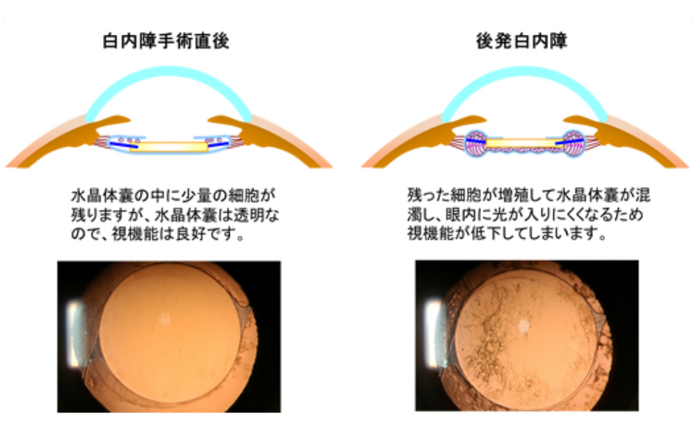 YAGレーザー（後発白内障）治療