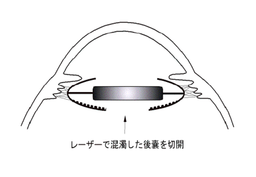 レーザーで混濁した後嚢を切開