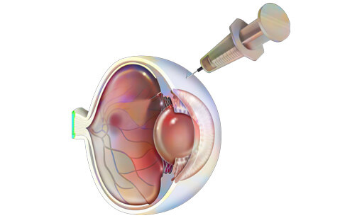 抗VEGF療法（硝子体注射）