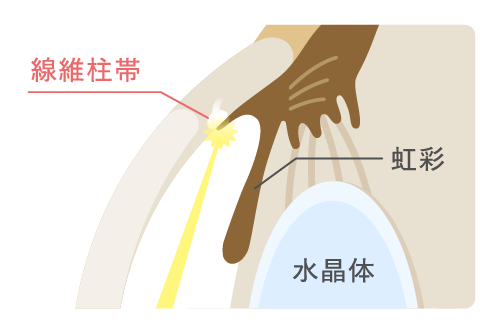 レーザー治療