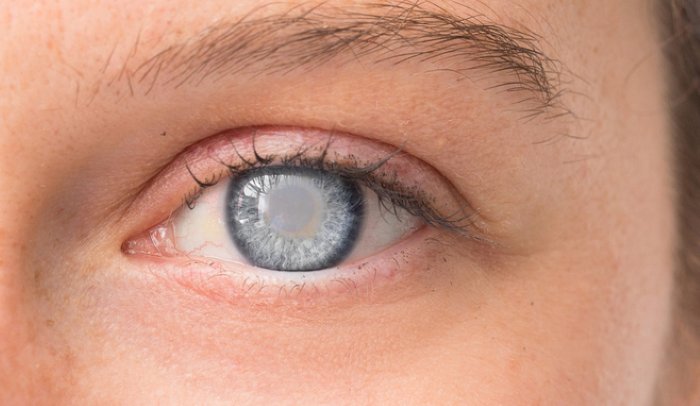 白内障の治療法について解説|進行度別の選択肢と注意点